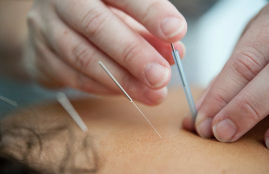 acupuncture pendant les règles